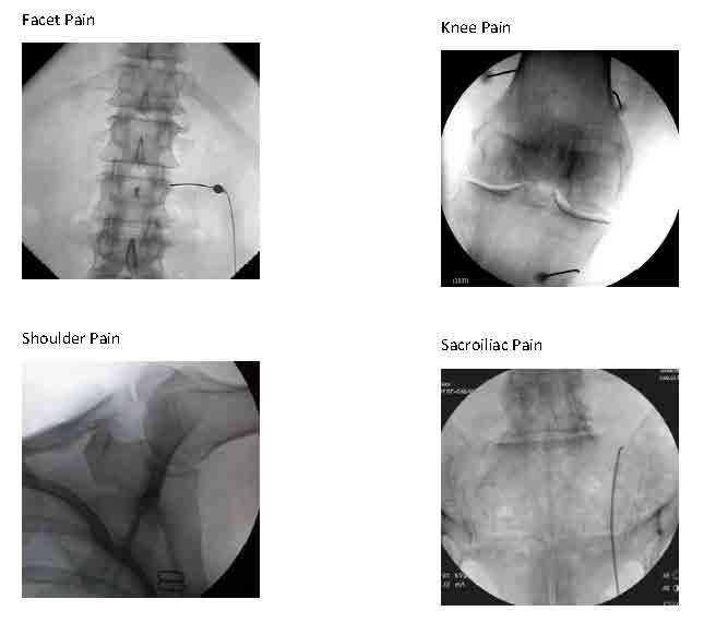 RADIOFREQUENCY_ABLATION_Web_2